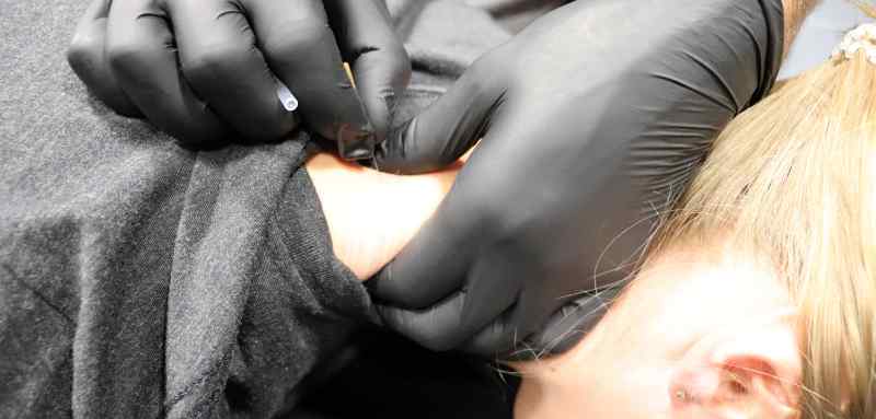 Dry Needling Adams Performance Physical Therapy